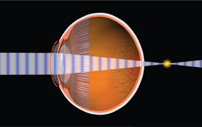 Myopia hyperopia astigmatism and presbyopia